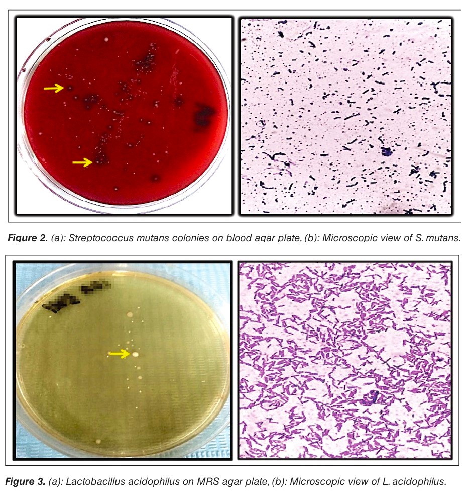 Turmeric Gel as Alternative Non-Vital Pulpotomy Medicament in Primary teeth- A Randomized Controlled Trial